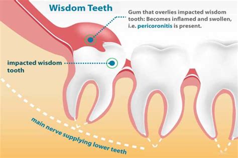 How Do I Know My Wisdom Teeth Are Growing Teethwalls