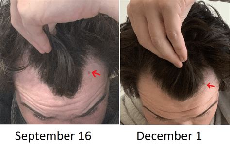 One Month Of Hair Regrowth From Vitamin D Magnesium Zinc And Vitamin