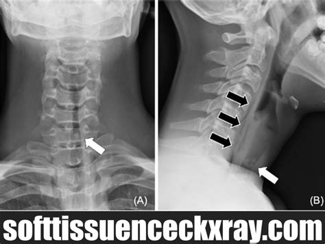 Ap And Lateral Soft Tissue Of Neck X Rays Soft Tissue Neck X Ray