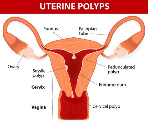 Uterine Polyps Endometrial Polyp Causes Symptoms Treatment