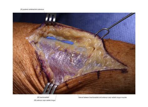 Posterior Interosseous Nerve Release Surgical Education Learn