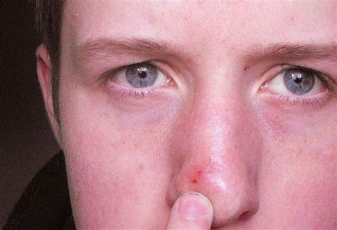 How To Get Rid Of Blind Pimples On My Nose Quora