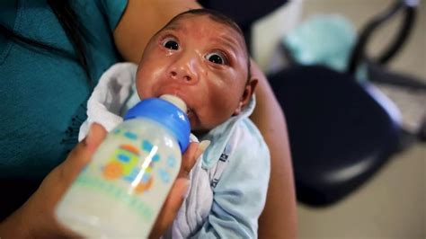 Zika Virus First Baby Born In Europe With Defect Linked To Infection