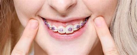 How To Tell If You Need Braces 5 Signs Its Time To Straighten Things