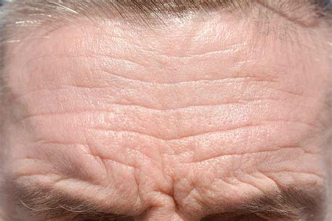 How Do You Relax Forehead Wrinkles Sjcsks