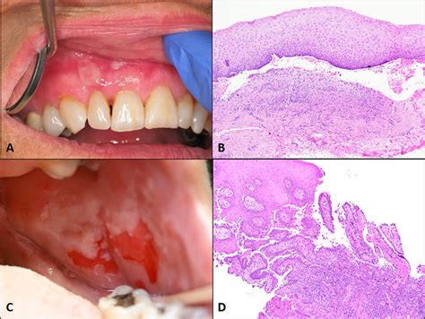 Vesiculobullous Immune Related Ulcerations A Mucous Membrane