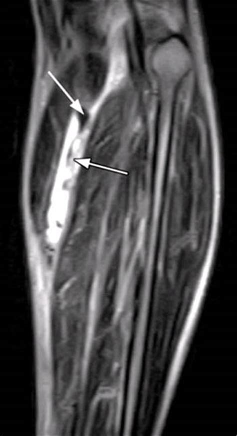 Peroneal tendon injuries are common in athletes, including runners, who participate in sports that require repetitive ankle motion. Tennis Leg / Plantaris Tendon Rupture - Radsource