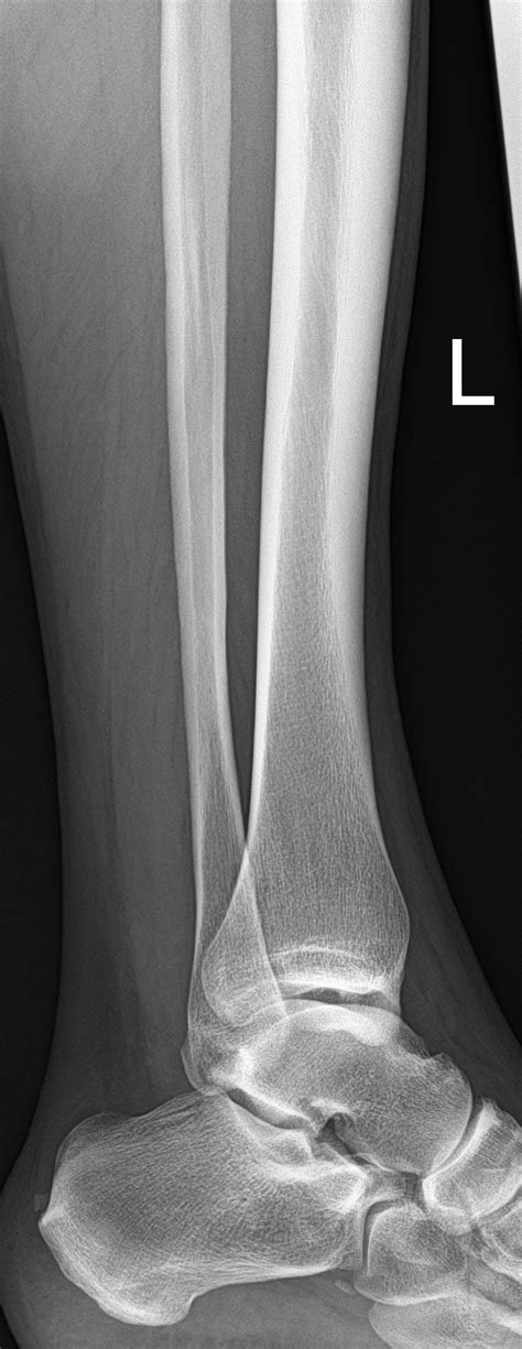 Medial Tibial Stress Syndrome Image