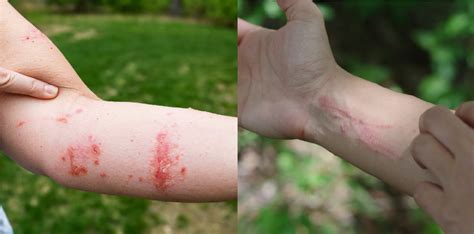 What Does Poison Ivy Rash Look Like On The Body