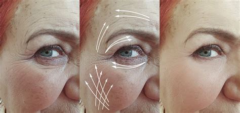 Elderly Woman Face Removal Collagen Wrinkles Tension Regeneration