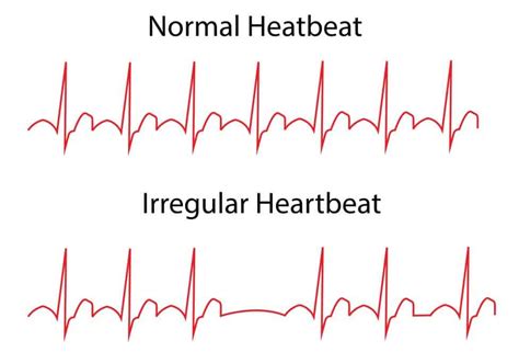 Heart Arrhythmias Types Causes And Prevention