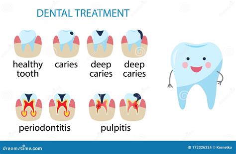Teeth Caries Stages Pulpitis Periodontitis Enamel Caries Vector