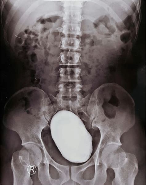 Plain Abdominal Radiograph Showed A Large Round Calcified Pelvic