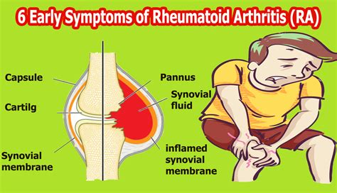 6 Early Symptoms Of Rheumatoid Arthritis Ra Rheumatoid Arthritis