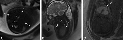 Mr Imaging Of Fetal Goiter American Journal Of Neuroradiology