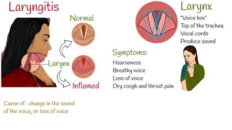 understanding laryngitis causes symptoms and treatment ask the nurse expert