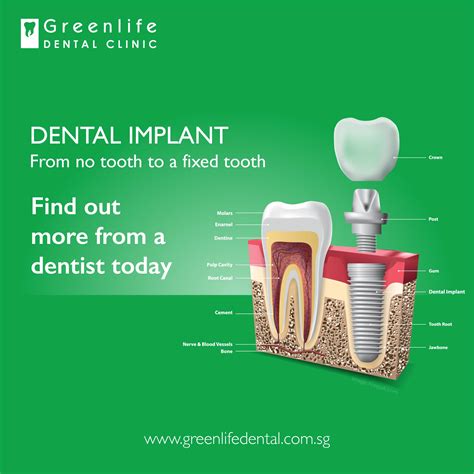 Ada accepted · 55 years of innovation · dentist recommended How much does a dental implant cost? | Greenlife Dental