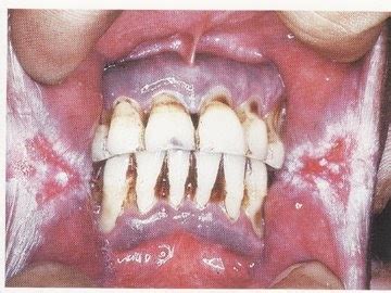 Like you're developing asthma or have gotten out of shape. stop smoking now / throat cancer tumor - NamesakExperT