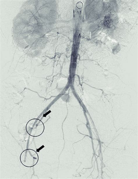 Pelvic Aortography Irregularity Of Aortic Lumen Occlusion Of The