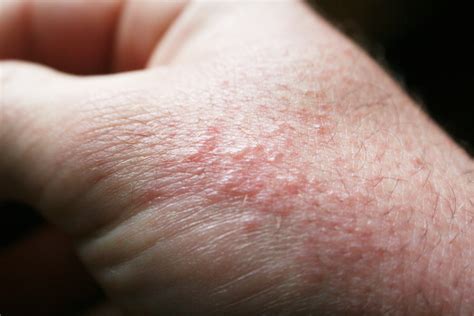 Common Summer Rashes And How To Prevent Them Institute Of Living
