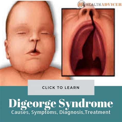 Digeorge Syndrome Causes Picture Symptoms And Treatment