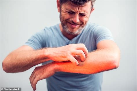 Ask The Gp What Can I Do About My Unbearable Itch Dr Martin Scurr