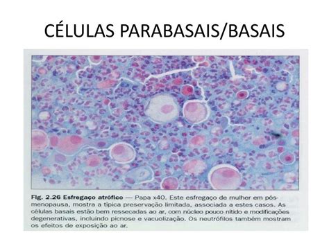 Elementos Da Zona De Transformação / Células Glandulares Endocervicais Presentes
