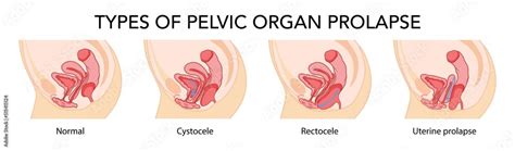 Set Of Prolapses Types Pelvic Organ Cystocele Uterine Rectocele