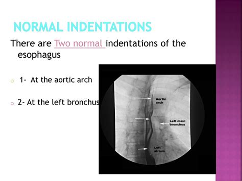 Ppt Barium Swallow Powerpoint Presentation Free Download Id2506514