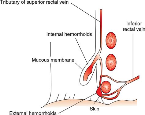Thrombosed Hemorrhoid Incision And Drainage