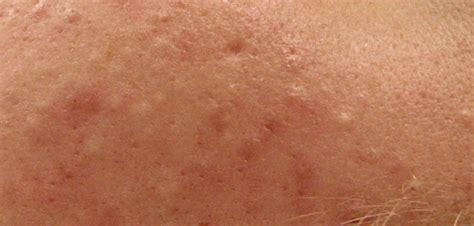What Is A Whitehead Acne Treatment Center Portland Or Oregon
