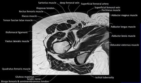 The abductor muscles of the hip were studied by using the variations in individual and composite muscular anatomy were recorded. MRI anatomy of hip joint | free MRI axial hip anatomy ...