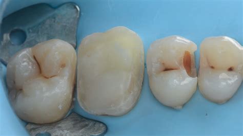 DIRECT AND INDIRECT RESTORATIONS IN THE SAME QUADRANT PERFORMED WITH