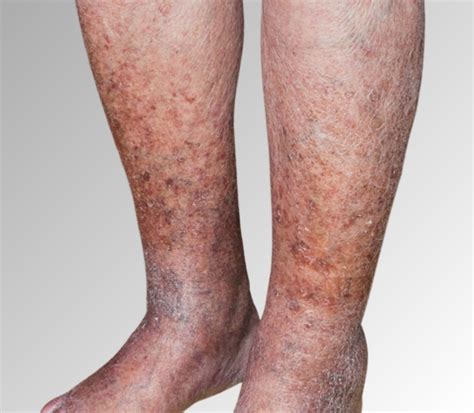 Stasis Dermatitis — Medical Secrets