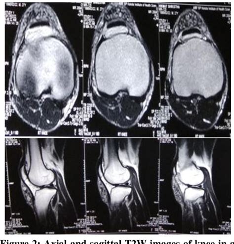 Figure 2 From Chronic Fungal Infrapatellar Bursitis With Dot In Circle