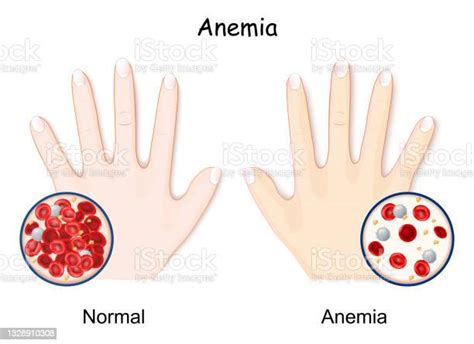 Anemia Hand Of Healthy Human And Anaemia Stock Illustration Download
