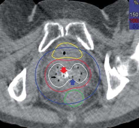 Axial computed tomography (CT) image of the bladder (yellow line ...