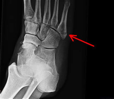 Avulsion fracture separation of a small fragment of bone cortex at the site of attachment of a ligament or tendon. Foot x-rays - Don't Forget the Bubbles