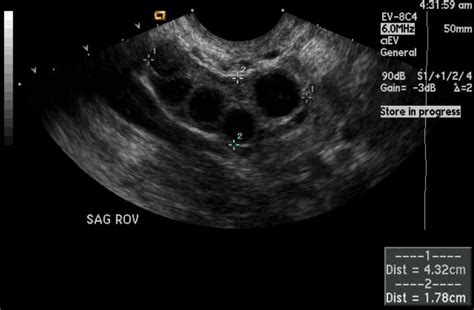 Ovarian Hyperstimulation Syndrome Image Radiopaedia Org