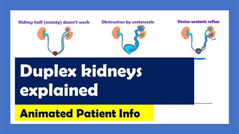 Duplex Kidneys Animated Patient Info Youtube