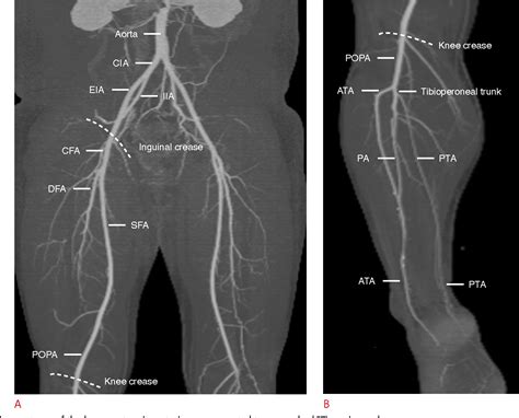 Doppler Ultrasound Of Lower Limb Arteries Vascular Ultrasound Lower