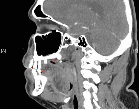 Bilateral Maxillary And Mandibular Periapical Abscesses Cureus