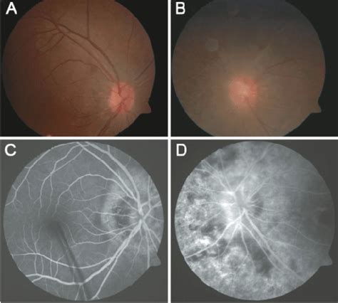 Fundus Photographs Showing A A Mildly Abnormal Foveal Reflex Normal