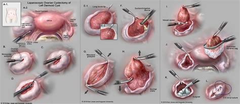 Laparoscopic Left Dermoid Ovarian Cystectomy Illustration By Keri Leigh