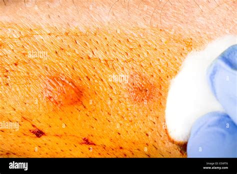 Iodine Wound Hi Res Stock Photography And Images Alamy