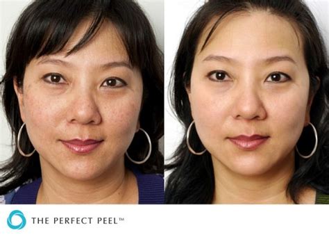The Perfect Derma Peel Delivers A Great Skin Peel After Only One Treatment