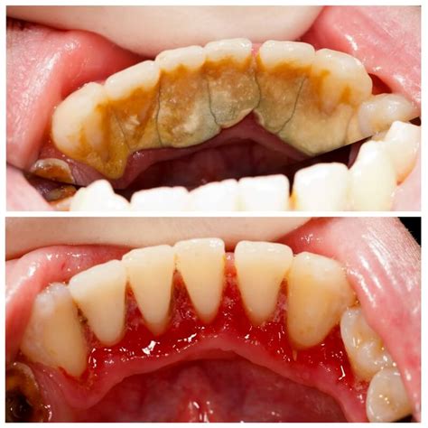Professional cleaning of teeth with a laser has an action mechanism, which is directly related to the difference in the amount of water in the tooth enamel and in to date, there is a lot of disagreement over whether the professional cleaning of teeth is harmful. Teeth Cleaning Before and After - Teeth FAQ Blog