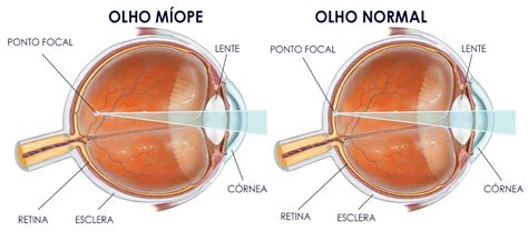 Miopia Ghisi Oftalmoclínica