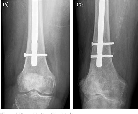 Figure 1 From Biomechanical Behavior Of Dynamic Vs Static Distal