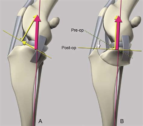 Figure 1 3 From Effects Of Tibial Plateau Leveling Osteotomy And Tibial